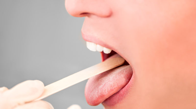 38+ Schleimhautveraenderungen im mund bilder , Schleimhautveränderungen im Mund Besser abklären lassen! MKG Praxis